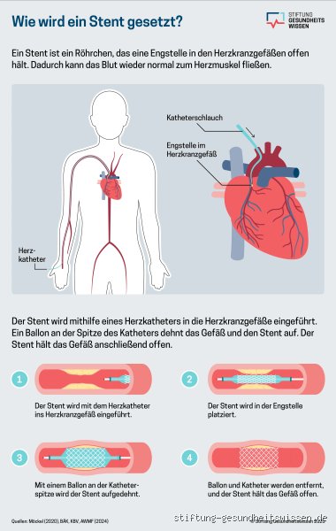 Wird ein Stent wirklich mit Narkose gesetzt? Alles, was du wissen musst