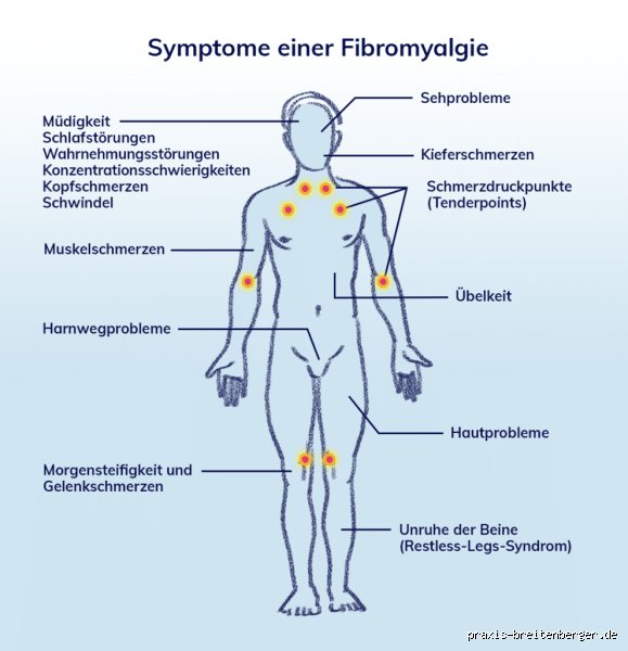 Wo befinden sich die Triggerpunkte bei Fibromyalgie?