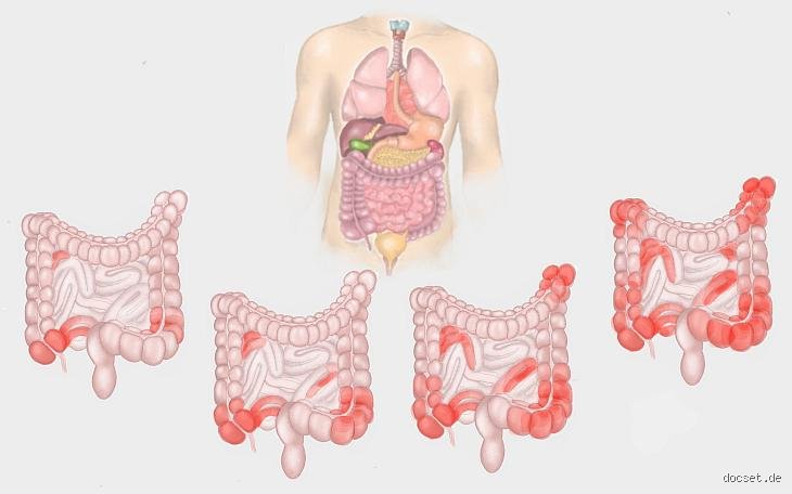 Wo tut Morbus Crohn weh? – Die Schmerzen verstehen und lindern