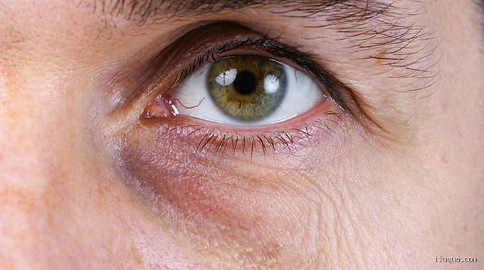 Plötzliche Augenringe: Warum sie entstehen und was man dagegen tun kann