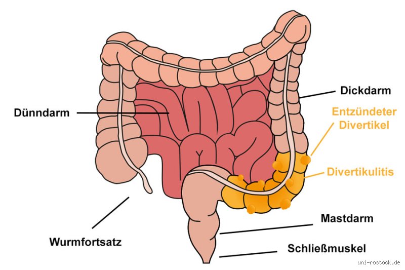 Woher kommt die Darmentzündung eigentlich? Die tiefere Wahrheit hinter den Ursachen