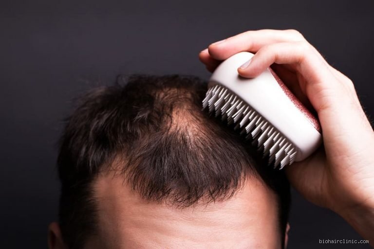 Sollte man bei Haarausfall Haare schneiden?
