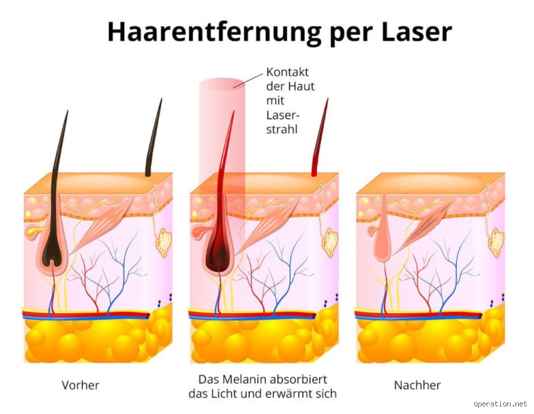 Welche Haarentfernung hält am längsten?