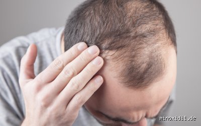 Welches Elternteil vererbt Haare?