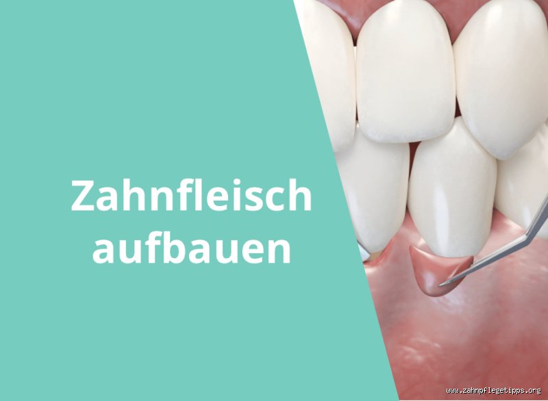 Zahnfleischaufbau: Wie lange dauert das denn nun wirklich?!