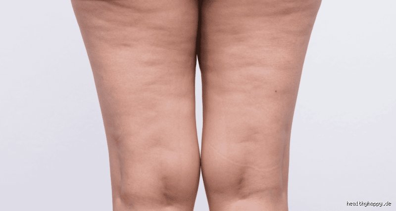 Warum habe ich plötzlich Cellulite? Meine ehrliche Suche nach Antworten auf die sichtbare Hautveränderung