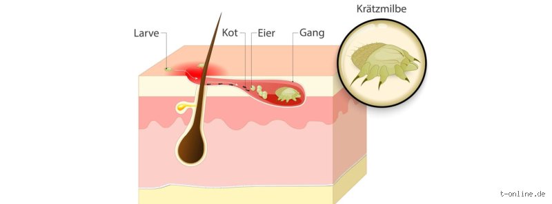 Wie sterben Milben auf der Haut? Alles, was du wissen musst