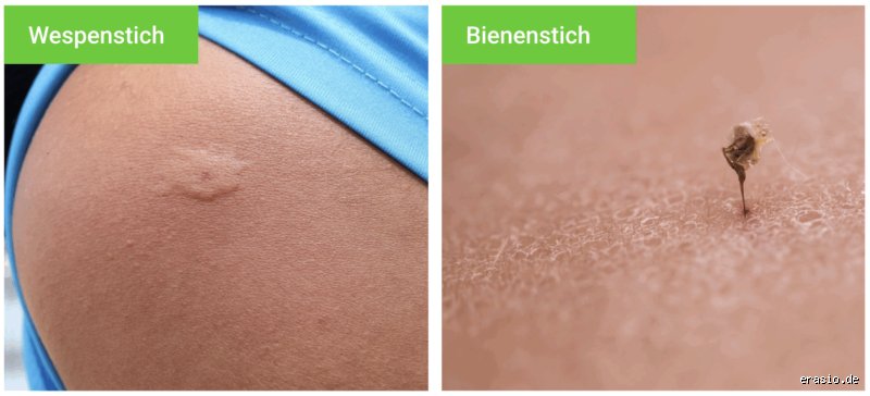Was tut mehr weh: Ein Bienenstich oder ein Wespenstich?