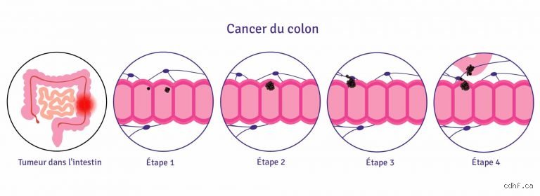 Comment on peut savoir si on a le cancer du colon ?