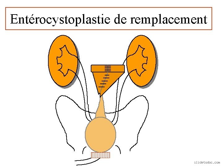 Comment s'appelle la chirurgie pour remonter la vessie ?
