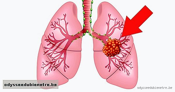 Comment savoir si un nodule au poumon est cancéreux ?
