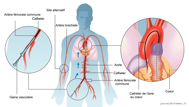 Comment se déroule l'angiographie ?