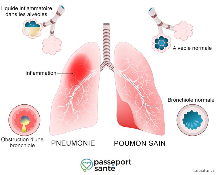 Comment une pneumonie arrive ?