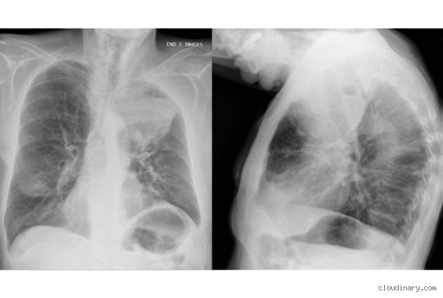 Emphysème pulmonaire : pourquoi la radio ne suffit pas (et ce qui marche vraiment)