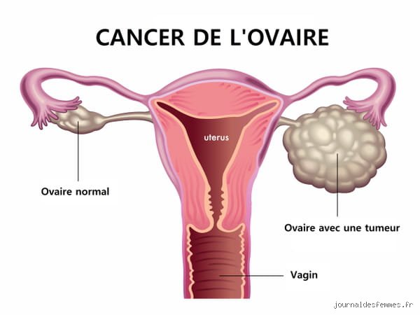 Est-ce que le cancer de l'ovaire évolue vite ?