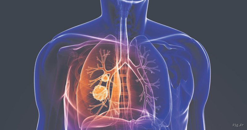 Est-il possible de survivre à un cancer du poumon ?