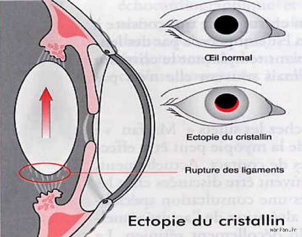 Pourquoi retirer le cristallin ?