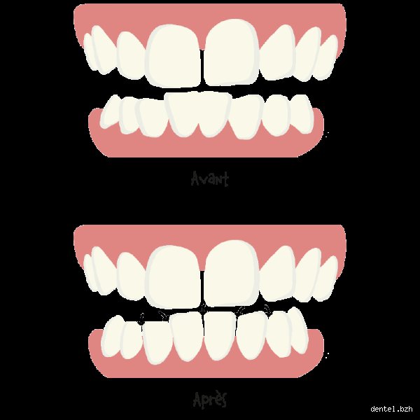Qu'est-ce que le stripping dentaire ? Comprendre la réduction amélaire en orthodontie
