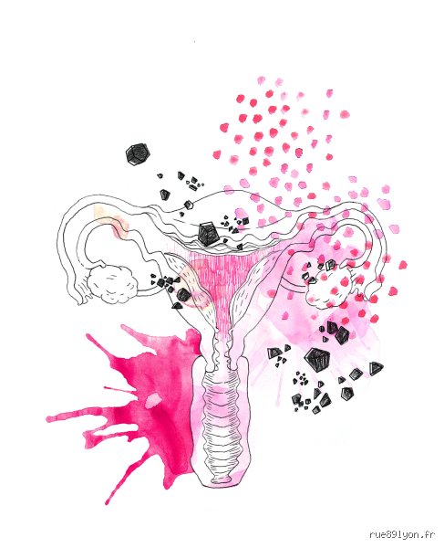 Quel est le cancer qui ne tue pas ? La vérité sur les tumeurs indolentes