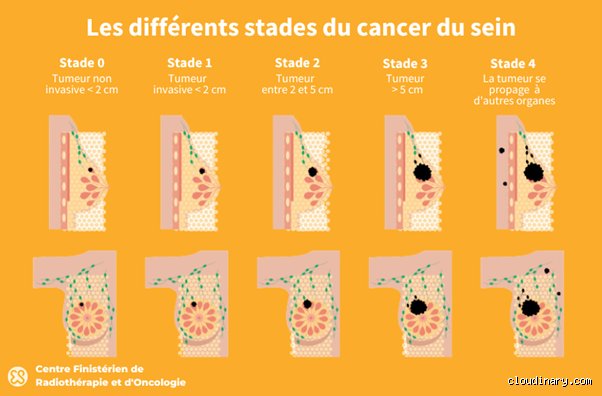 Quel est le dernier stade d'un cancer et qu'est-ce que cela implique réellement ?