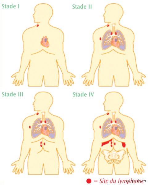 Quel est le signe avant-coureur d'un lymphome ?