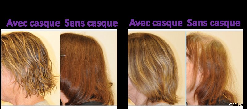 Quel est le taux de réussite de la chimiothérapie ? La vérité derrière les chiffres