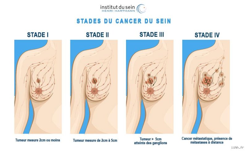 Métastases éclair : la science derrière un cancer qui se propage en deux semaines