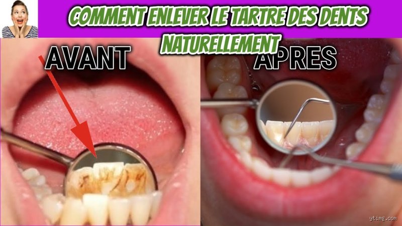 Comment enlever le tartre sur les dents du bas ?