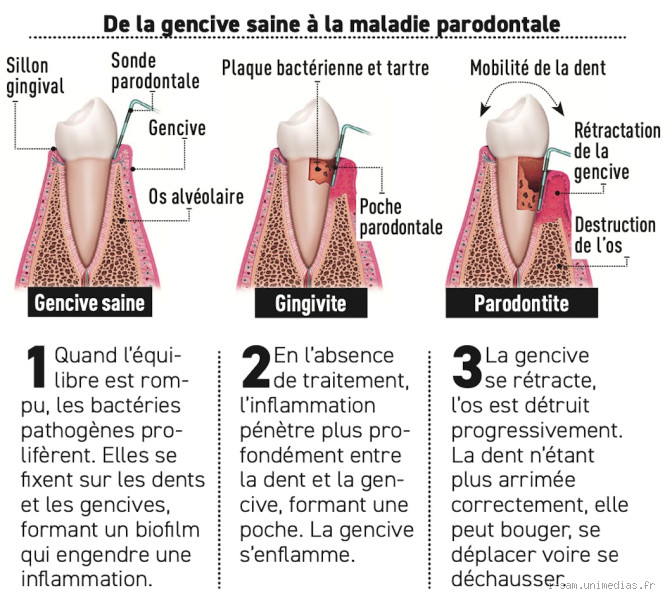 Comment éviter les dents qui se déchaussent ? Nos vraies solutions