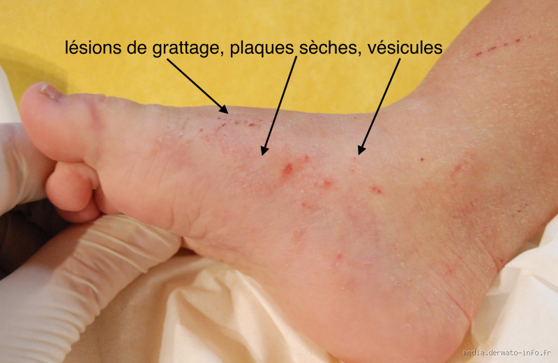 Pourquoi ça gratte aux chevilles ? Ce que votre peau veut vous dire