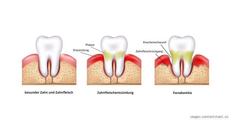 Entzündungshemmende Zahnwunder: Endlich Ruhe im Mund!