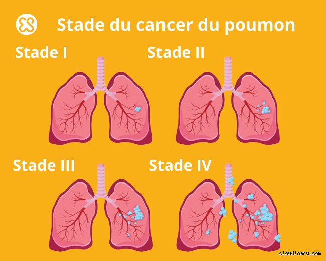 À quel stade du cancer du poumon la chimiothérapie est-elle nécessaire ? Analyse clinique et réalités thérapeutiques