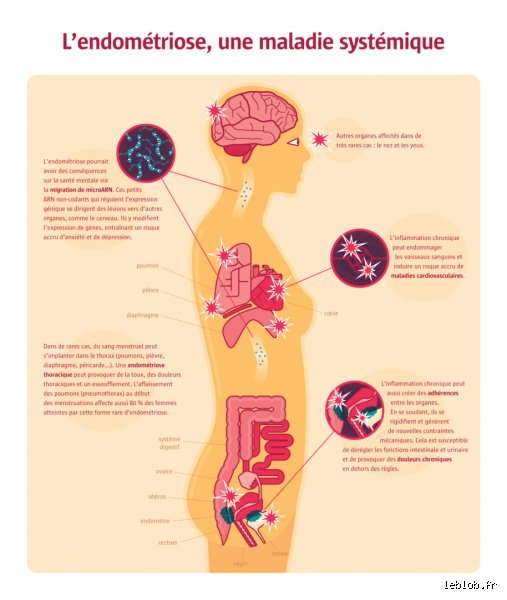 À quoi ressemble la douleur liée à l'endométriose : bien plus qu'une simple crampe, une réalité neurologique et physique complexe