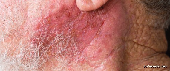 À quoi ressemble la vie après une radiothérapie ? Comprendre la transition complexe entre la fin des soins et la pleine récupération