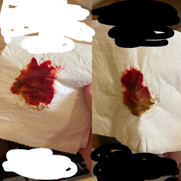 À quoi ressemble le sang d'un cancer du côlon sur du papier toilette ? Reconnaître les signes qui ne trompent pas