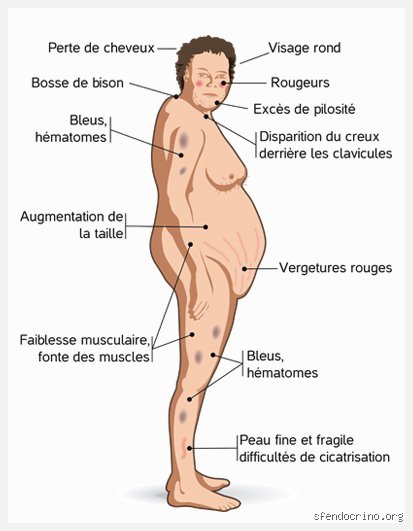 À quoi ressemble une personne atteinte de la maladie de Cushing ? Le portrait clinique d'un séisme hormonal méconnu