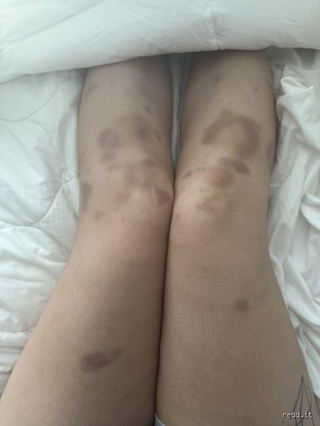 À quoi ressemblent des jambes anémiques ? Identifier les signes invisibles et les symptômes cutanés concrets