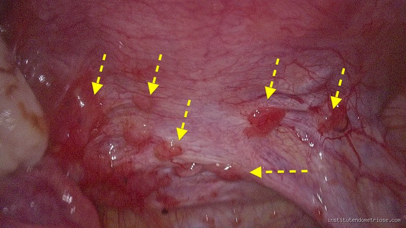À quoi ressemblent les lésions d'endométriose : l'atlas visuel d'une pathologie complexe que l'on découvre enfin