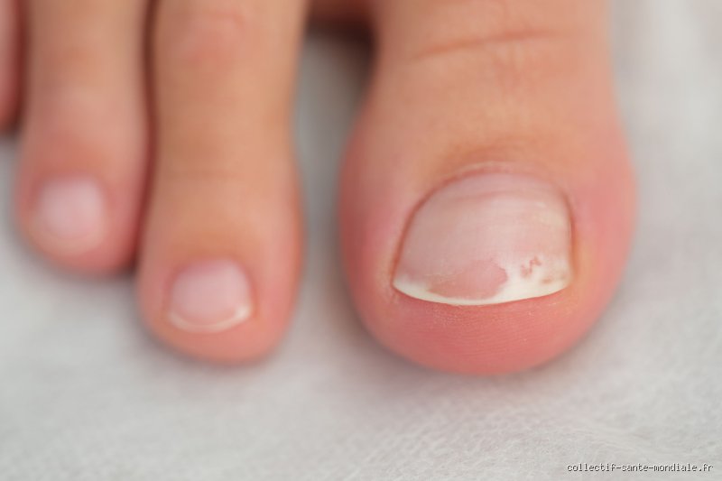 À quoi ressemblent les ongles en cas de maladie du foie : le guide expert pour décrypter ces signaux d'alerte silencieux