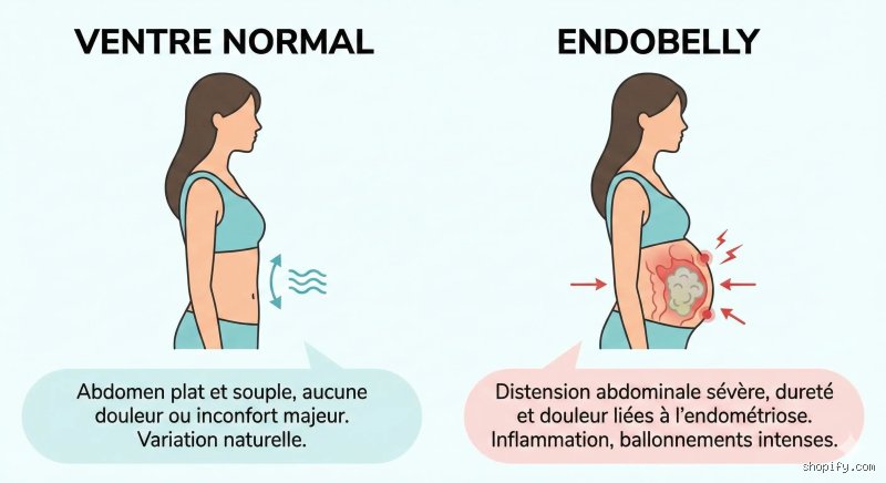 Ai-je un ventre dû à l'endométriose ou suis-je simplement grosse ? Le guide pour comprendre l'Endo Belly