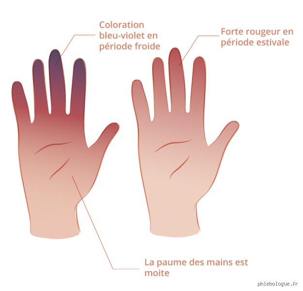 C'est quoi l'acrocyanose ? Comprendre ce trouble vasculaire bénin