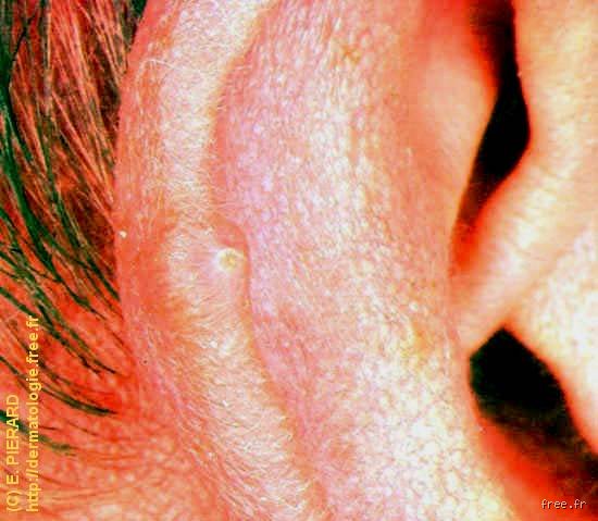 C'est quoi un nodule à l'oreille ?