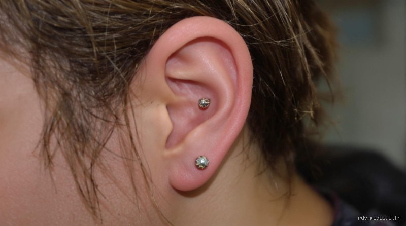 C'est quoi une chéloïde piercing ? Comprendre cette cicatrice hypertrophique spécifique