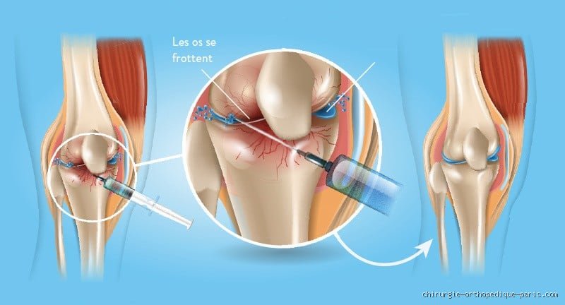 Combien coûte une injection d'acide hyaluronique au genou ? Le guide complet sur les tarifs pratiqués en 2026