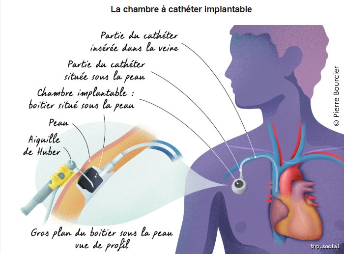 Combien de séances de chimio pour un cancer ? Le guide pour comprendre la durée réelle des protocoles
