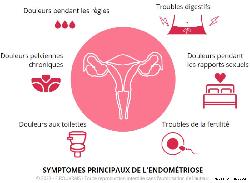 Combien de temps dure généralement une poussée d'endométriose : réalité médicale, variations individuelles et pièges du calendrier