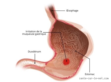 Combien de temps dure une gastrite aiguë ? Comprendre le délai de guérison réel et les facteurs qui ralentissent votre rétablissement