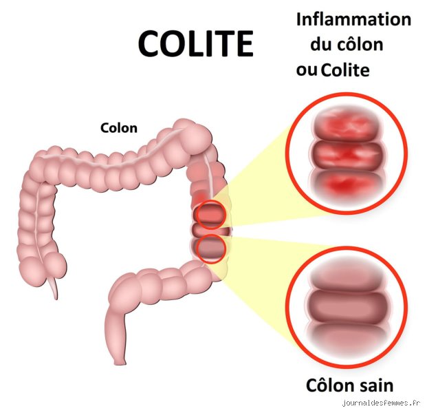 Combien de temps faut-il pour guérir d'une inflammation intestinale ? Le guide vérité sans tabou ni fausses promesses