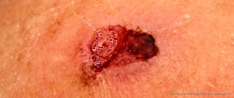 Combien de temps faut-il pour qu'un carcinome épidermoïde métastase ? La réalité brutale sur la vitesse de propagation de ce cancer cutané