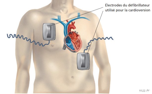 Combien de temps faut-il pour se remettre d’une cardioversion électrique ? Le guide complet pour retrouver son rythme sans brûler les étapes